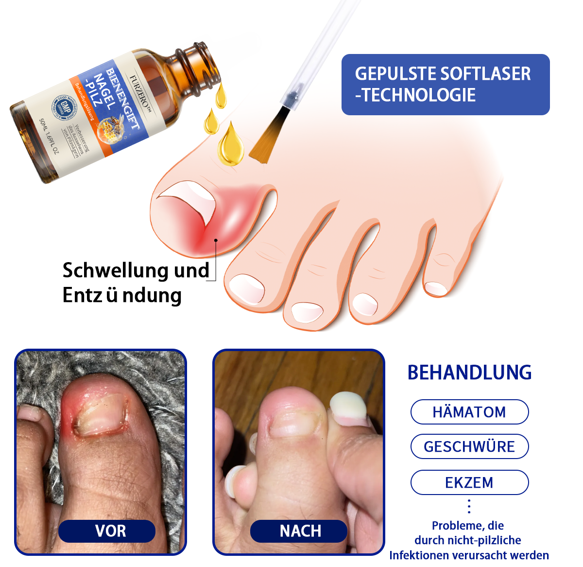 Furzero™ Bienengift Nagelpilz Behandlungslösung:Das Nagelpilzproblem vollständig lösen🌟
