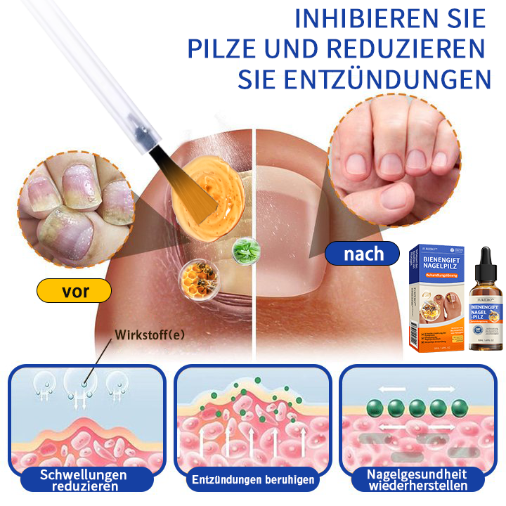 Furzero™ Bienengift Nagelpilz Behandlungslösung:Das Nagelpilzproblem vollständig lösen🌟