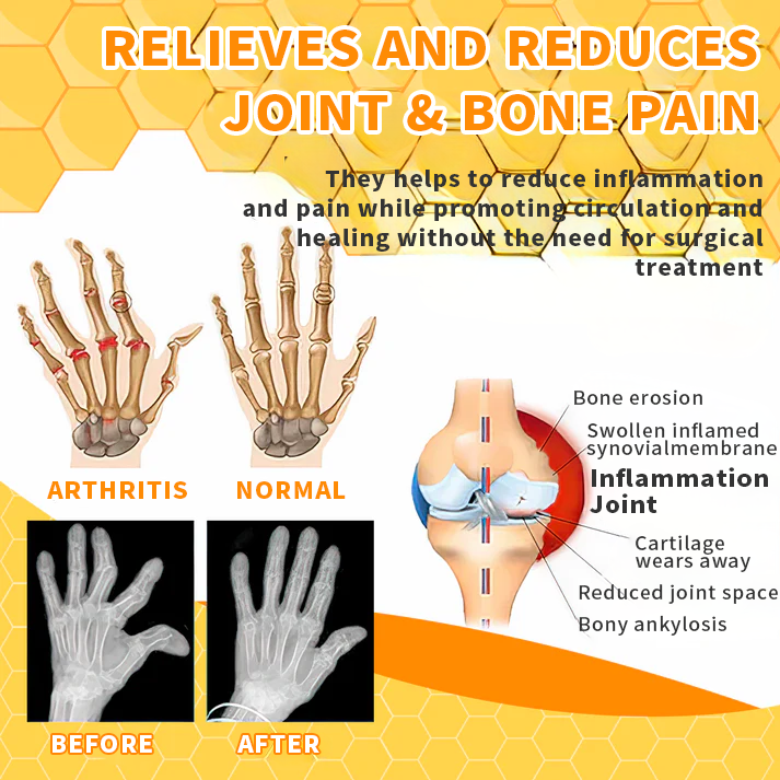 💎💎 Aeehfeng™ Bee Venom Joint Therapy Pain Relief Gel ( Špecializuje sa na ortopedické ochorenia a bolesti pri artritíde)