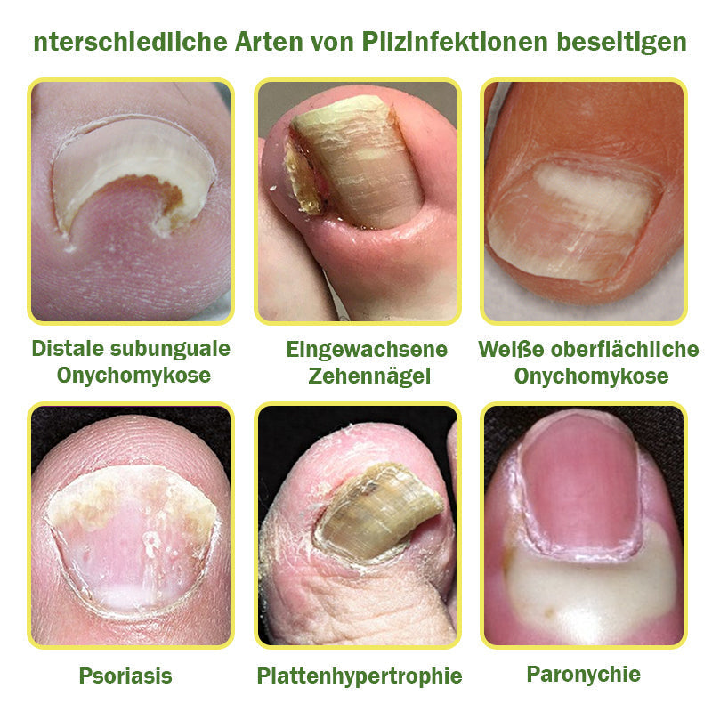 👩⚕️Furzero™ Ošetrujúce sérum proti problémom s nechtami s včelím jedom (Na všetky druhy ochorení nechtov✅Pre zdravší rast nechtov)