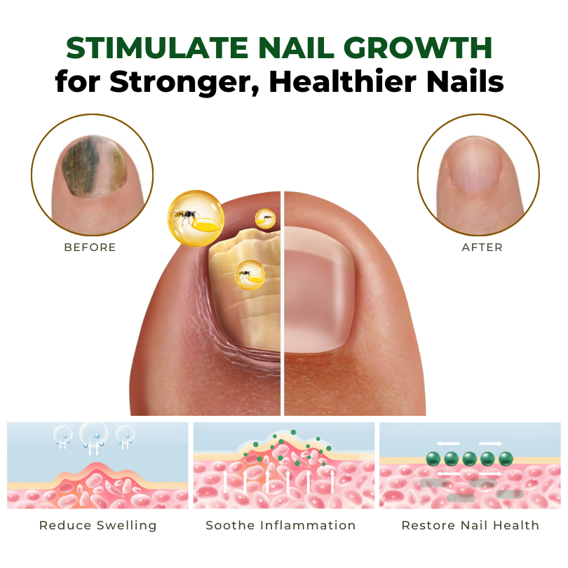 Biancat™ NailNurture Olej na liečbu plesní včelím jedom -👨⚕️ Schválila Americká dermatologická akadémia (AAD)
