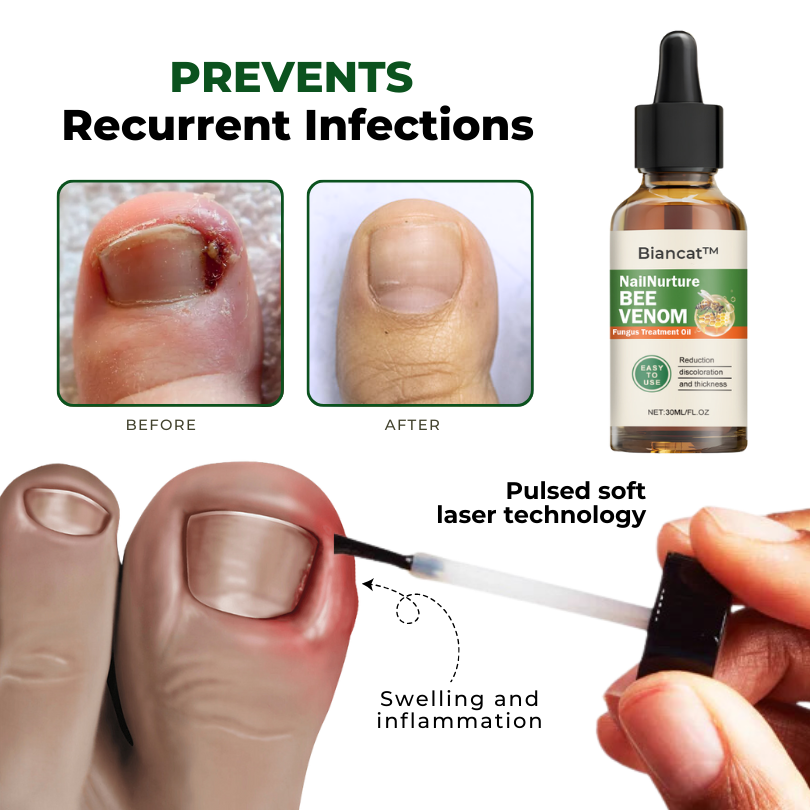 Biancat™ NailNurture Olej na liečbu plesní včelím jedom -👨⚕️ Schválila Americká dermatologická akadémia (AAD)