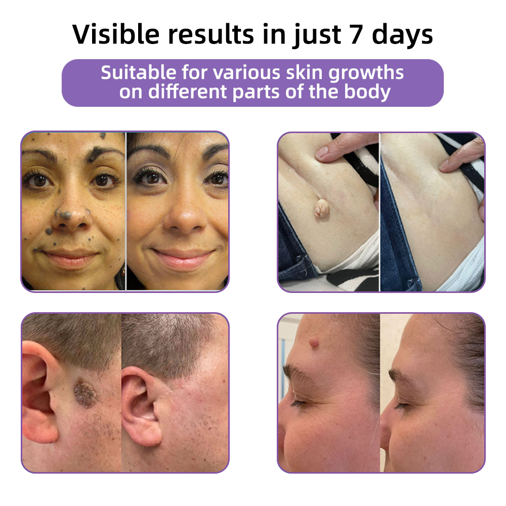 𝐓𝒐𝐭𝐚𝗹𝐧á 𝐬𝐞𝐛𝐚𝐬𝐭𝐞𝐣𝐧𝐨𝐬𝐭̌ 𝐳𝐚č𝐢́𝐧𝐚 𝐭𝐮✅ 𝐁𝒐𝒔𝐭𝒐𝐫𝗲® 𝐍𝐚𝐧𝐨 𝐦𝐢𝐜𝐫𝐨𝐢𝐈𝐧𝐞𝐞𝐝𝐥𝐞 𝐎𝐩𝐫𝐚𝐯𝐧á 𝐍á𝐥𝐞𝐩𝐤𝐚 𝐬 𝐊𝐲𝐬𝐞𝐥𝐢𝐧𝐨𝐮 𝐇𝐲𝐚𝐥𝐮𝐫𝐨́𝐧𝐨𝐯𝐨𝐮✴ Pre rôzne jazvy, strie, škvrny, keloidy, keratózy, akné, popáleniny, bradavice, kožné výrastky a kŕčové žily.