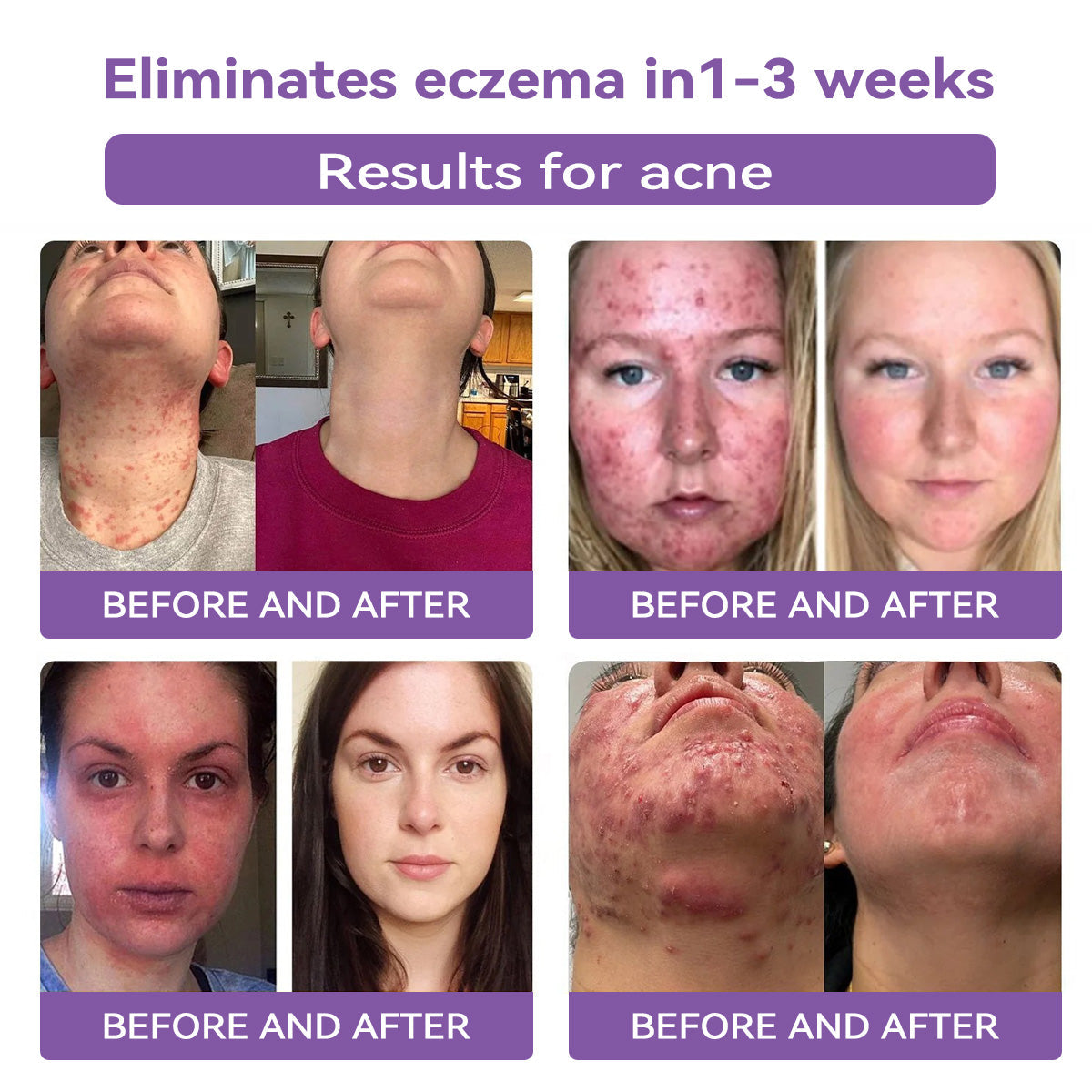 𝐓𝒐𝐭𝐚𝗹𝐧á 𝐬𝐞𝐛𝐚𝐬𝐭𝐞𝐣𝐧𝐨𝐬𝐭̌ 𝐳𝐚č𝐢́𝐧𝐚 𝐭𝐮✅ 𝐁𝒐𝒔𝐭𝒐𝐫𝗲® 𝐍𝐚𝐧𝐨 𝐦𝐢𝐜𝐫𝐨𝐢𝐈𝐧𝐞𝐞𝐝𝐥𝐞 𝐎𝐩𝐫𝐚𝐯𝐧á 𝐍á𝐥𝐞𝐩𝐤𝐚 𝐬 𝐊𝐲𝐬𝐞𝐥𝐢𝐧𝐨𝐮 𝐇𝐲𝐚𝐥𝐮𝐫𝐨́𝐧𝐨𝐯𝐨𝐮✴ Pre rôzne jazvy, strie, škvrny, keloidy, keratózy, akné, popáleniny, bradavice, kožné výrastky a kŕčové žily.