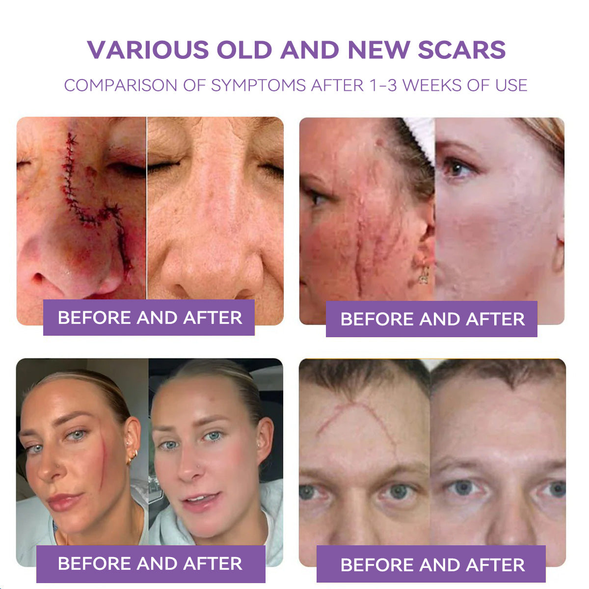 𝐓𝒐𝐭𝐚𝗹𝐧á 𝐬𝐞𝐛𝐚𝐬𝐭𝐞𝐣𝐧𝐨𝐬𝐭̌ 𝐳𝐚č𝐢́𝐧𝐚 𝐭𝐮✅ 𝐁𝒐𝒔𝐭𝒐𝐫𝗲® 𝐍𝐚𝐧𝐨 𝐦𝐢𝐜𝐫𝐨𝐢𝐈𝐧𝐞𝐞𝐝𝐥𝐞 𝐎𝐩𝐫𝐚𝐯𝐧á 𝐍á𝐥𝐞𝐩𝐤𝐚 𝐬 𝐊𝐲𝐬𝐞𝐥𝐢𝐧𝐨𝐮 𝐇𝐲𝐚𝐥𝐮𝐫𝐨́𝐧𝐨𝐯𝐨𝐮✴ Pre rôzne jazvy, strie, škvrny, keloidy, keratózy, akné, popáleniny, bradavice, kožné výrastky a kŕčové žily.