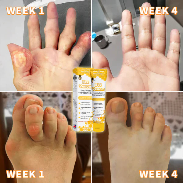 💎💎 Aeehfeng™ Bee Venom Joint Therapy Pain Relief Gel ( Špecializuje sa na ortopedické ochorenia a bolesti pri artritíde)