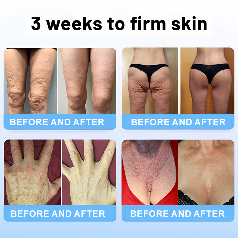 ✨💧Flysmus® Skin Firming Cream,Addressing Crepe & Sagging