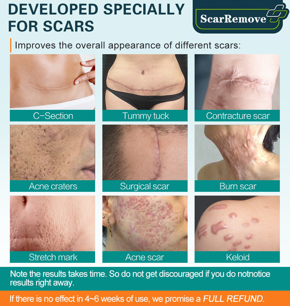 🔥🔥🔥ScarRemove™ Advanced Scar Spray na všetky typy jaziev - najmä jazvy po akné, chirurgické jazvy a strie