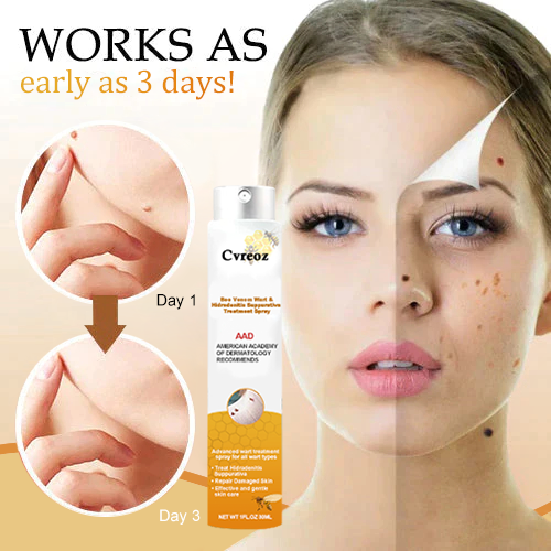 🧡Cvreoz Bee Venom Wart and Tags Removal Treatment Spray(👨⚕AAD RECOMMENDS)🐝🐝(🔥Last day promotion 80% off)