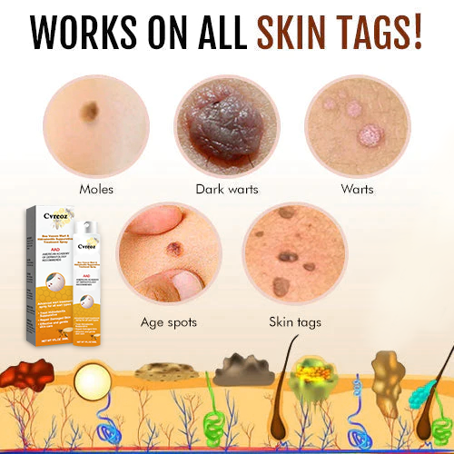 🧡Cvreoz Bee Venom Wart and Tags Removal Treatment Spray(👨⚕AAD RECOMMENDS)🐝🐝(🔥Last day promotion 80% off)