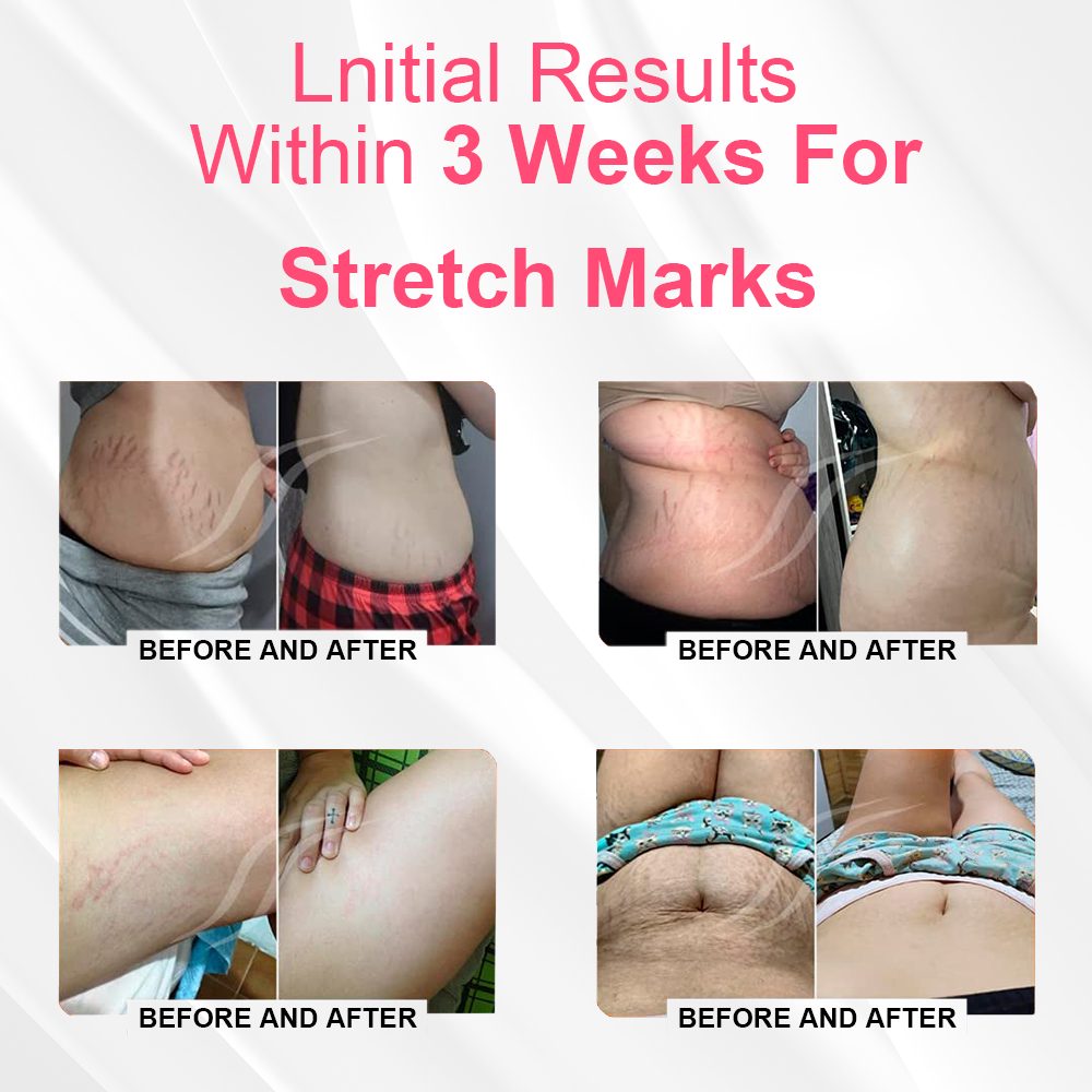 ANYIDEA™ Magnetické nano ióny spaľovanie tukov brucha ovládanie detoxikačné Shaper