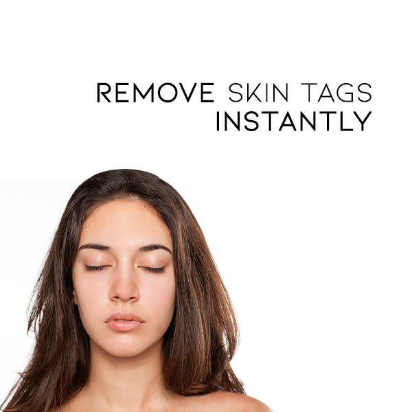 🧡Cvreoz Bee Venom Wart and Tags Removal Treatment Spray(👨⚕AAD RECOMMENDS)🐝🐝(🔥Last day promotion 80% off)