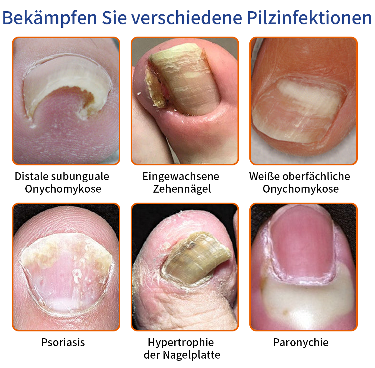 Furzero™ Bienengift Nagelpilz Behandlungslösung:Das Nagelpilzproblem vollständig lösen