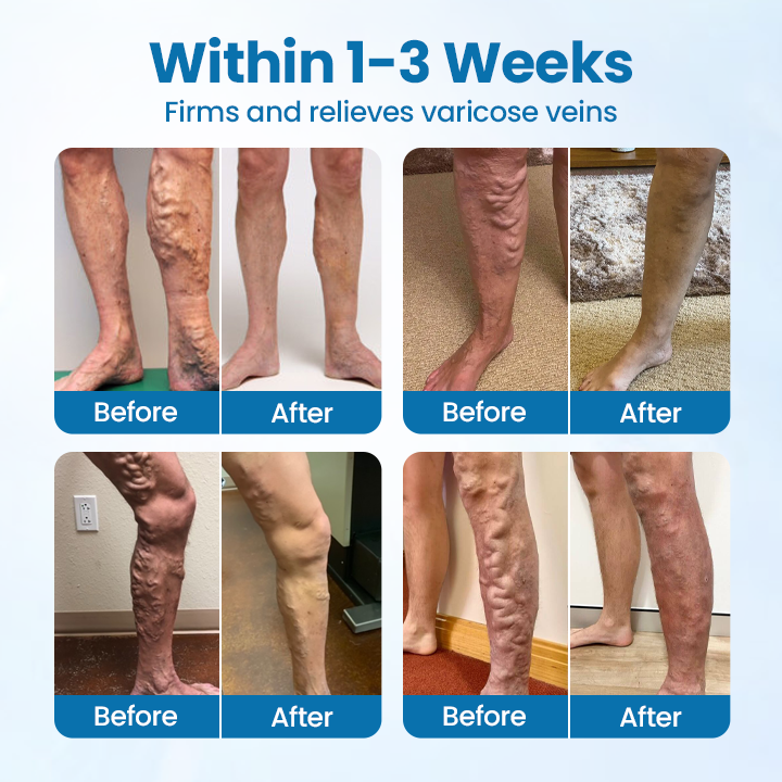 Timilk® VeinGuard bylinný sprej -✅ Klinicky preukázané odstránenie kŕčových žíl už za 7 dní!